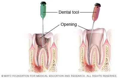 root canal tooth
